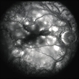 Recurrent Pseudotumor with Scleritis